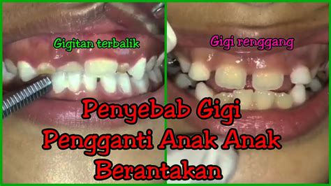 Penyebab Dari Gigi Pergantian Anak Anak Menjadi Tidak Rapi Alias