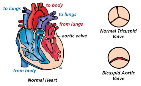 Bicuspid Aortic Valve Leeds Teaching Hospitals Nhs Trust