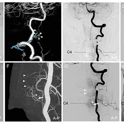 Postoperative Follow Up Angiography Angiography Was Performed Two Weeks