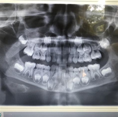 My six year old got an X-ray. The result was amazing. : r/pics