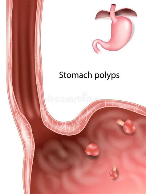 Polyps In Stomach Gastric Polyp Stock Vector Illustration Of Gastroenterology Gastritis