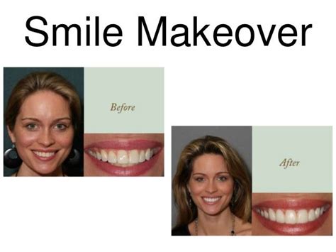 Cosmetic Dentist charlotte NC Smile Makeover