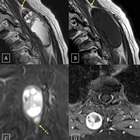 Pre Operative Mri A Sagittal T2 Weighted B Sagittal T1 Weighted Download Scientific