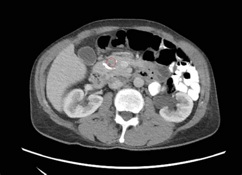 Contrast enhanced CT scan of pancreas. | Download Scientific Diagram