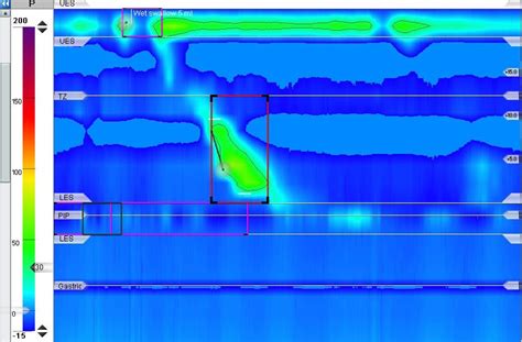 A Esophageal High Resolution Manometry Image At Baseline Showing