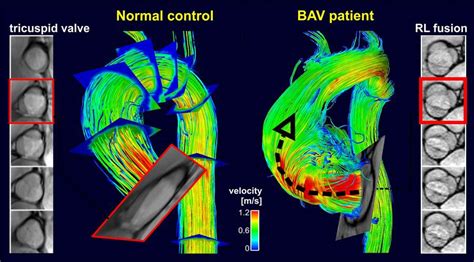 Bicuspid Aortic Valve (BAV) Treatment | Lurie Children's