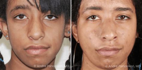 Patient 389213 Smile Reanimation Before And After Photos Andre