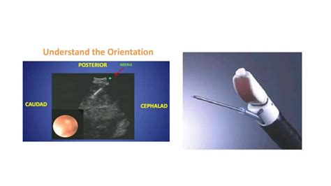 Endobronchial Ultrasound Ebus Ppt