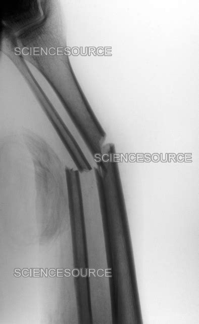 Fractured Tibia and Fibula, X-ray | Stock Image - Science Source Images