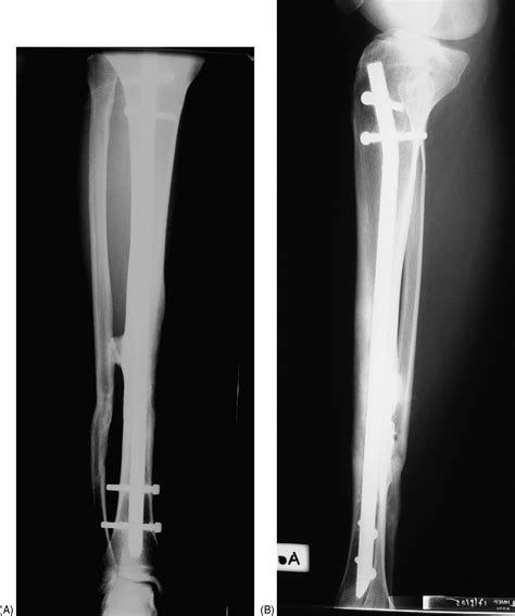 Eight Years Clinical Experience With The Orthofix Tibial Nailing