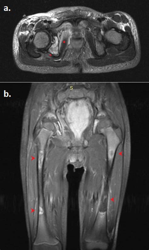 Hip, pelvis, and femur MRI STIR sequence. a) Axial view illustrating... | Download Scientific ...