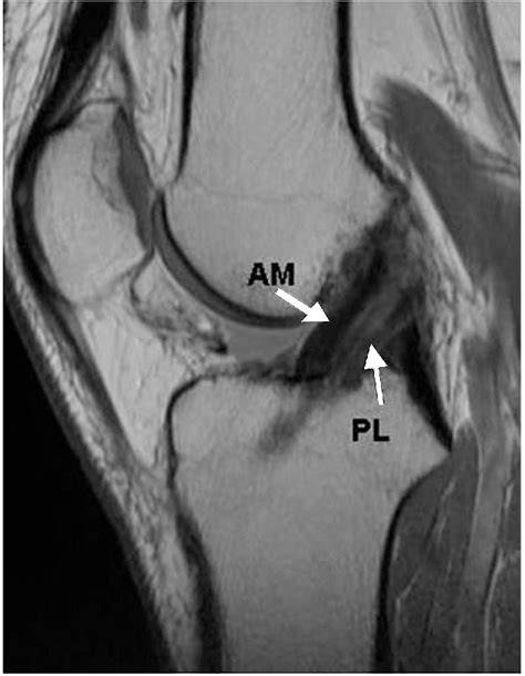 Figure 5 From Piia Suomalainen Anterior Cruciate Ligament Double Bundle