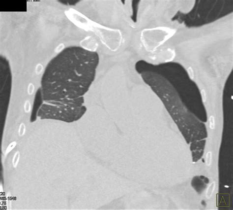 Bilateral Pneumothorax Chest Case Studies Ctisus Ct Scanning