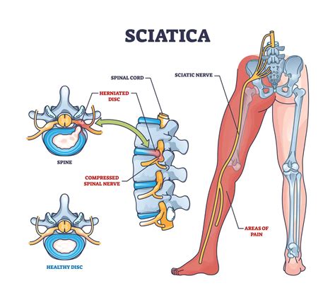 How To Exercise Safely With Sciatica