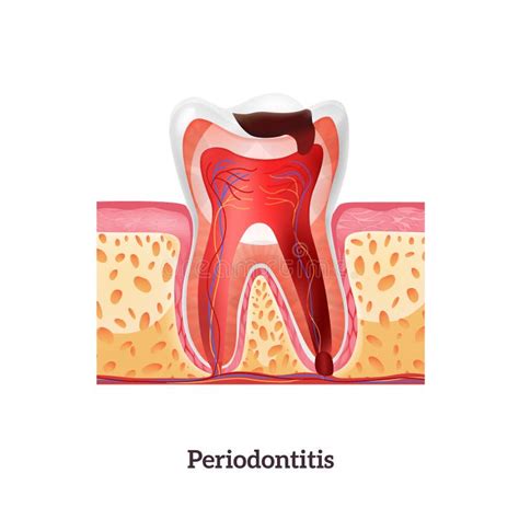 Periodontitis Realistic Illustration Stock Vector Illustration Of