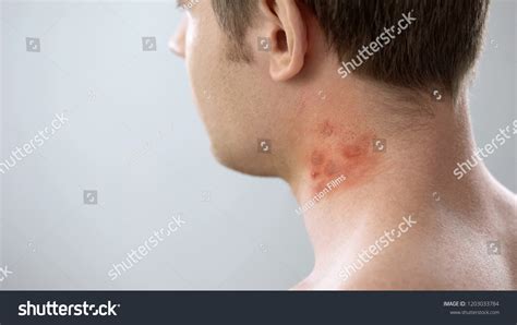 Red Spots On Male Patient Neck 스톡 사진 1203033784 Shutterstock