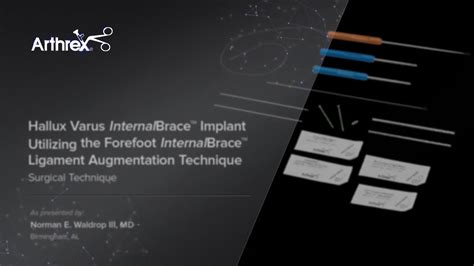 Arthrex Hallux Varus Internalbrace™ Repair Using The Forefoot