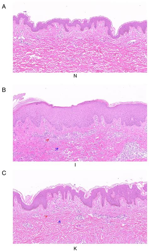 Histological Images Of Healthy Skin Inflamed Tissue And Keloid Tissue