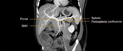 Abdominal Ct Abdominal Veins • Litfl • Radiology Library