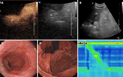 Gastroesophageal Junction Ultrasound