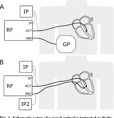 Figure From Bipolar Radiofrequency Catheter Ablation For Ventricular