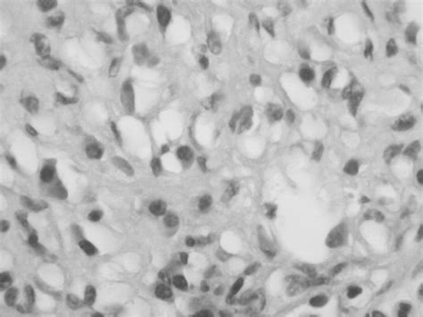 Signet Ring Cells Of Stromal Derivation In The Uterine Cervix Secondary