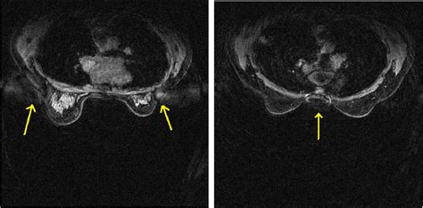 Figure 1 From Evaluation Of Aliasing Artifact Reduction In Spiralrodeo