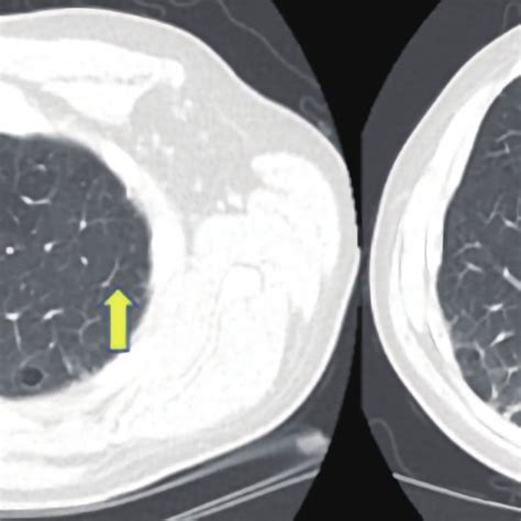 Computed Tomography Pulmonary Angiogram Ctpa Of The Chest In Lung