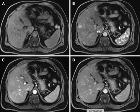 Imaging Evaluation Of The Liver In Oncology Patients A Comparison Of Techniques