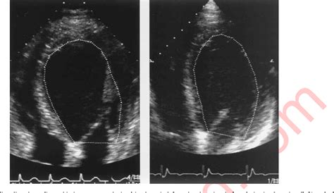 Figure 1 from Impact of cardiac resynchronization therapy using ...