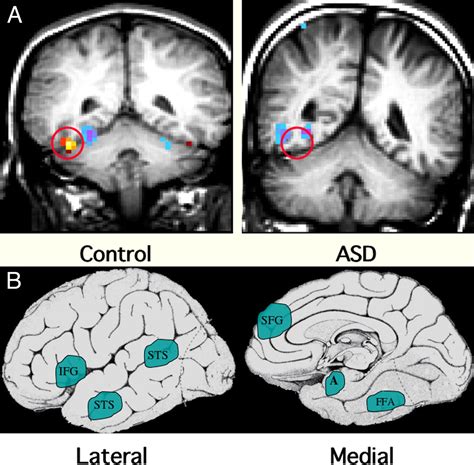 Autism And The Brain Neurophenomenological Interpretation