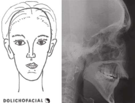 5 Vertical Facial Growth Long Face Phenotype Download Scientific