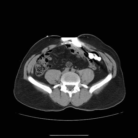 Colo Cutaneous Fistula Radiology Reference Article Radiopaedia Org