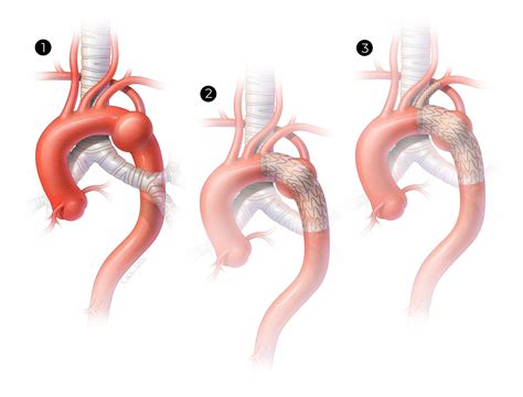 Scvs Treatment Of Blunt Traumatic Aortic Injury With Aberrant Right Subclavian Artery