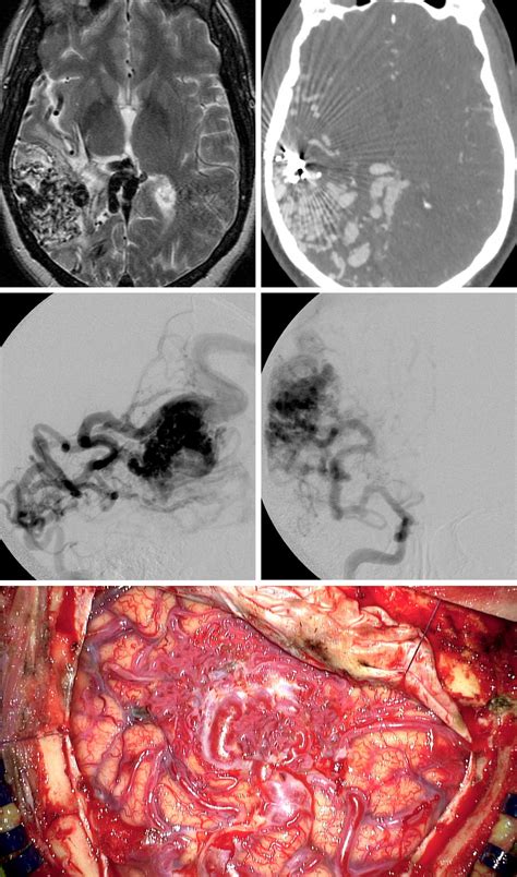 Giant Avms The Neurosurgical Atlas