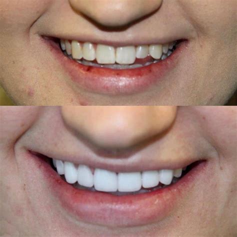 Before And After Fairbanks Dental Associates In Temple TX