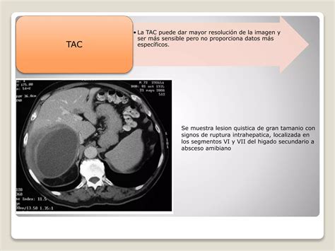 Absceso Hepatico Ppt