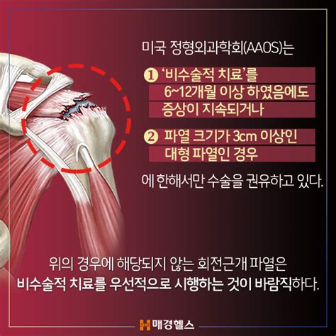 카드뉴스 어깨 회전근개 파열 수술 전 고려할 치료는