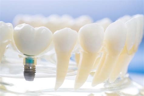 6 Steps of a Dental Implant Procedure | Dental Implants TX