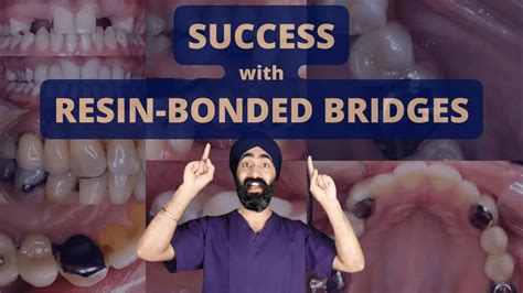 Success With Resin Bonded Bridges Aka Adhesive Bridges Or Formerly