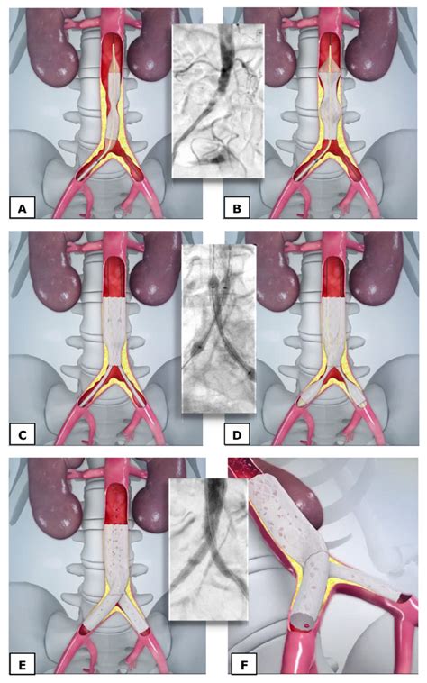 Cerab Technique To Replace Aorto Bifemoral Bypass Is Heating Up