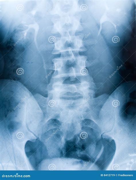 Xray Of The Spine Stock Photography | CartoonDealer.com #49028480