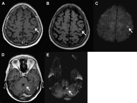 Diffusion MR Imaging An Important Tool In The Assessment Of Brain