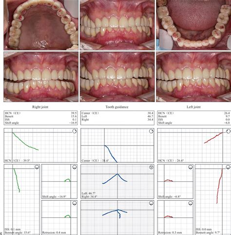 Case Of Precise Full Mouth Occlusal Reconstruction Guided By Digital