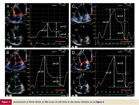 Pdf Improvement Of Atrial Function And Atrial Reverse Remodeling