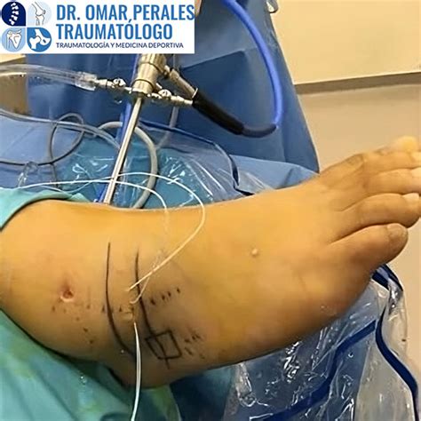 Cirugia De Fractura De Tobillo En Lima Dr Omar Perales