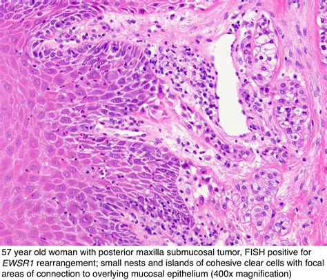 Pathology Outlines Clear Cell Carcinoma