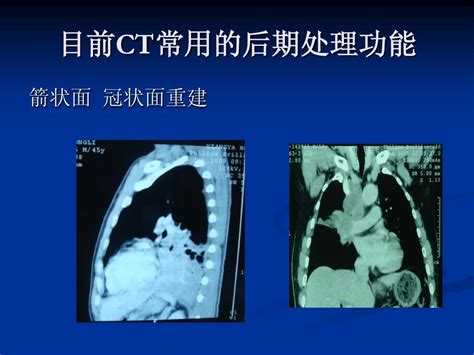 胸部ct阅片word文档在线阅读与下载无忧文档