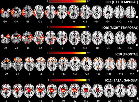 Frontiers Neuroanatomical Correlates Of Screening For Aphasia In