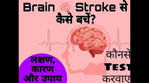 What Is A Stroke Types Of Stroke Symptoms Causes Diagnosis Treatment Youtube